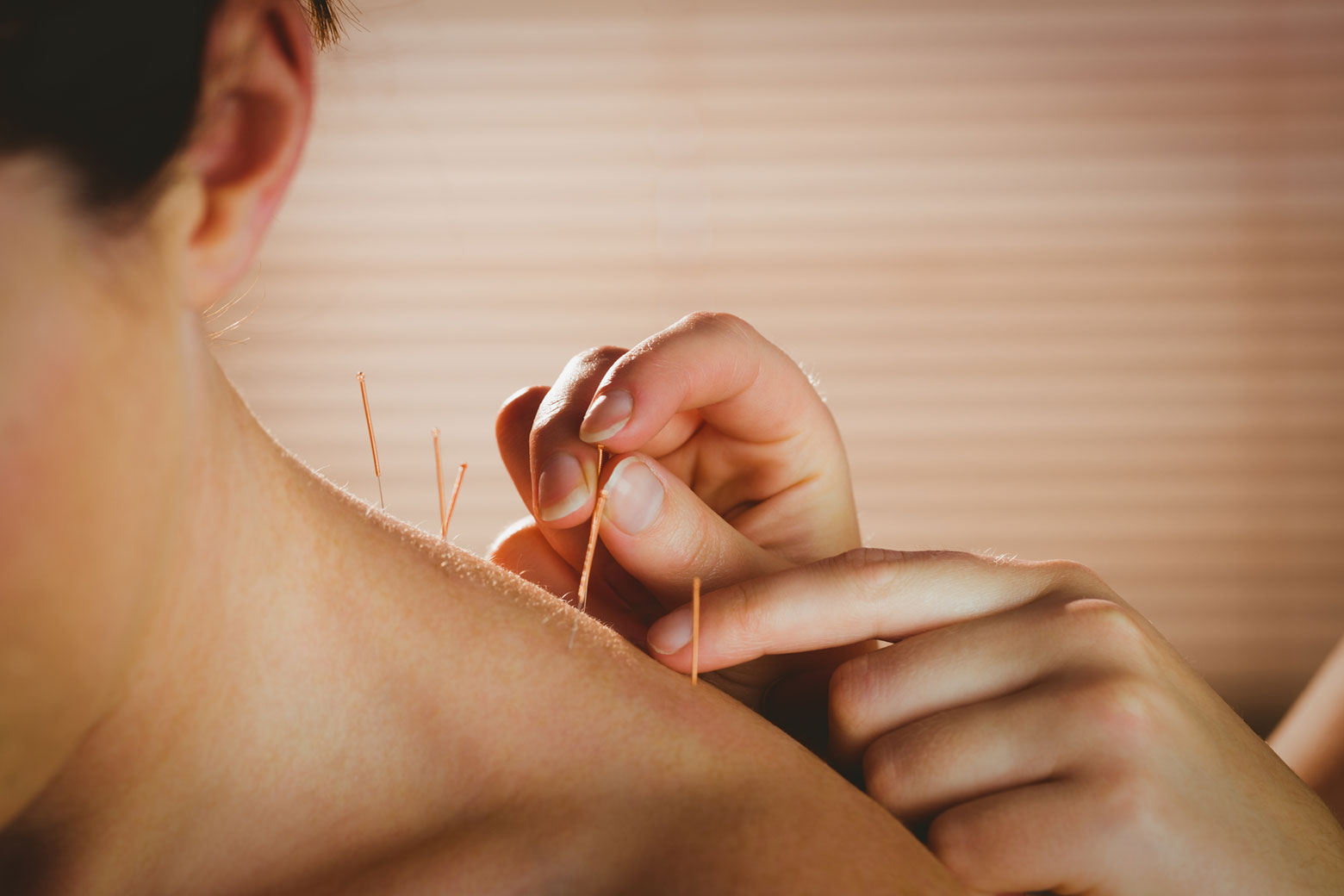 Acupuncture at Seva Physical Therapy NYC