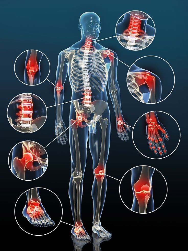 Osteoarthritis illustration