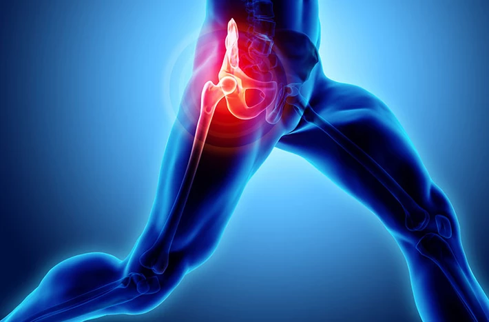 Hip illustration