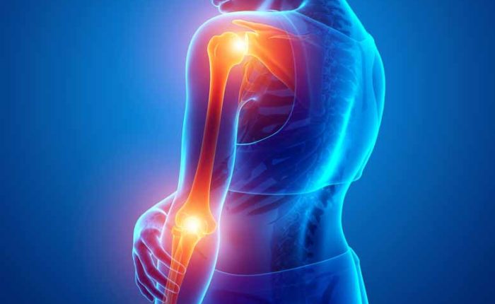 Tendinitis illustration